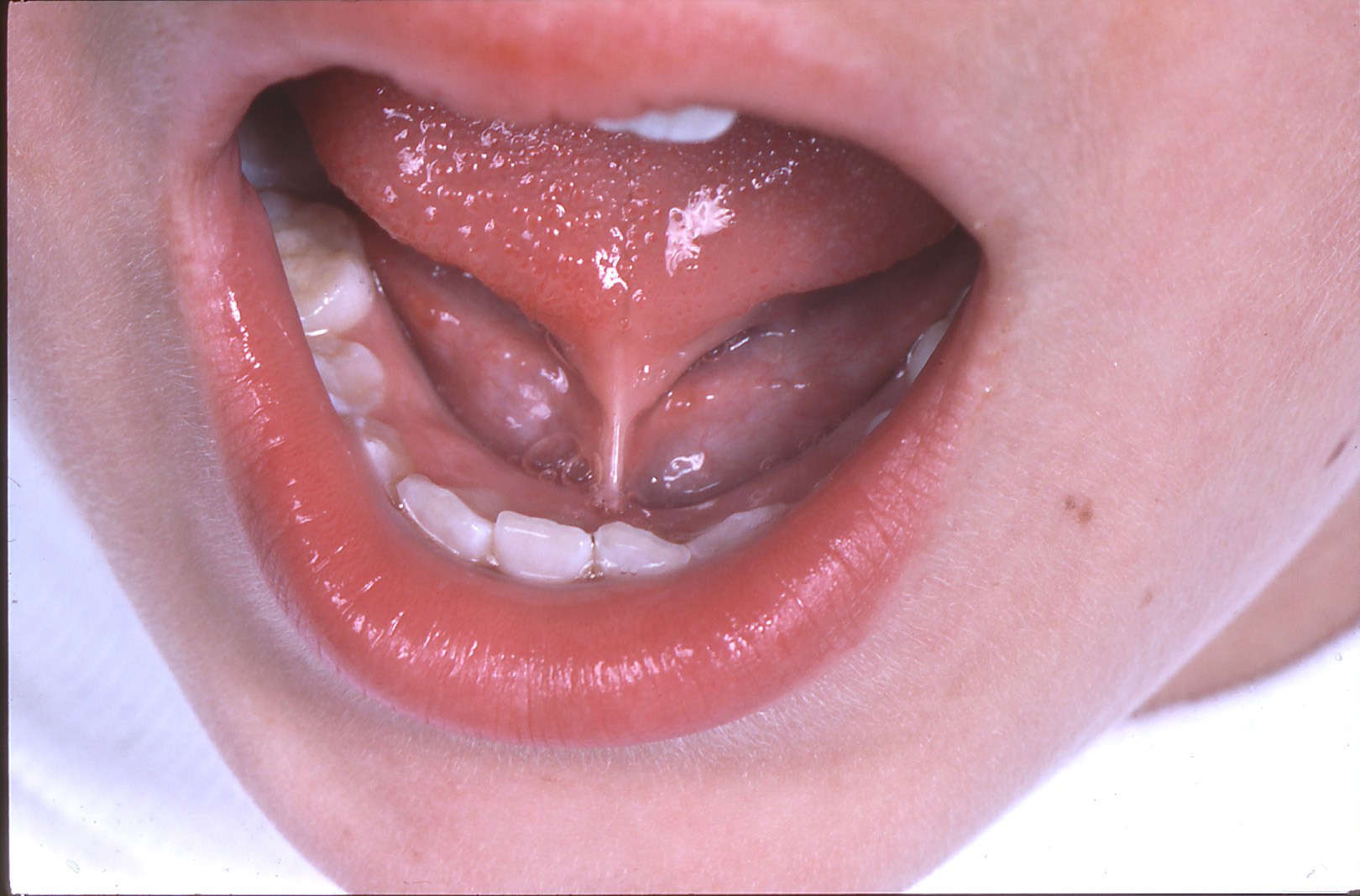 is-tongue-tie-being-overtreated